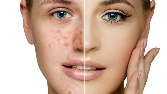 Krem na trądzik różowaty - jaki wybrać? Zobacz ranking