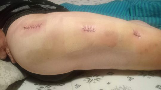 Zbiórka na wsparcie leczenia i rehabilitację